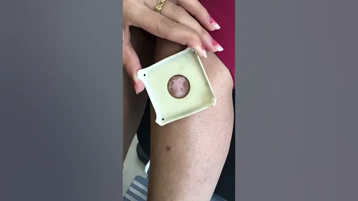 Eximer Laser Treatment for Vitiligo, Psoriasis and Alopecia Areata #adivacenterforskinandhair - DayDayNews