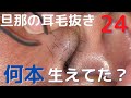 【旦那の耳毛24】　何本抜けるか数えてみた　ear hair plucking