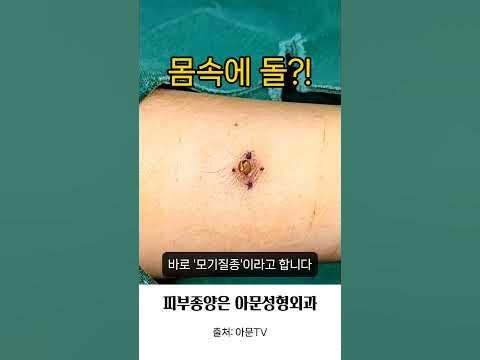 몸속에 돌? 모기질종 (핀홀법 수술 피지낭종 회색 점 수술 성형외과 병원 흉터 Stone Pilomatricoma Surgery ...