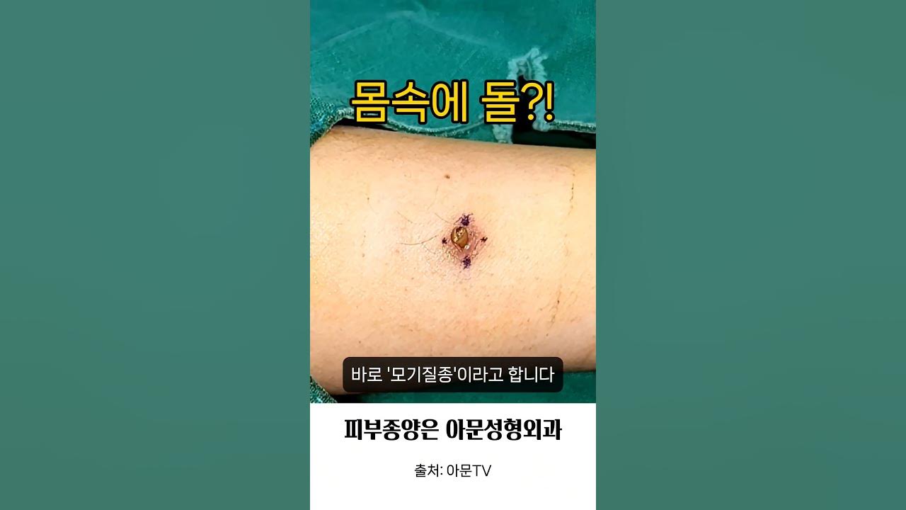 몸속에 돌? 모기질종 (핀홀법 수술 피지낭종 회색 점 수술 성형외과 병원 흉터 Stone Pilomatricoma Surgery ...
