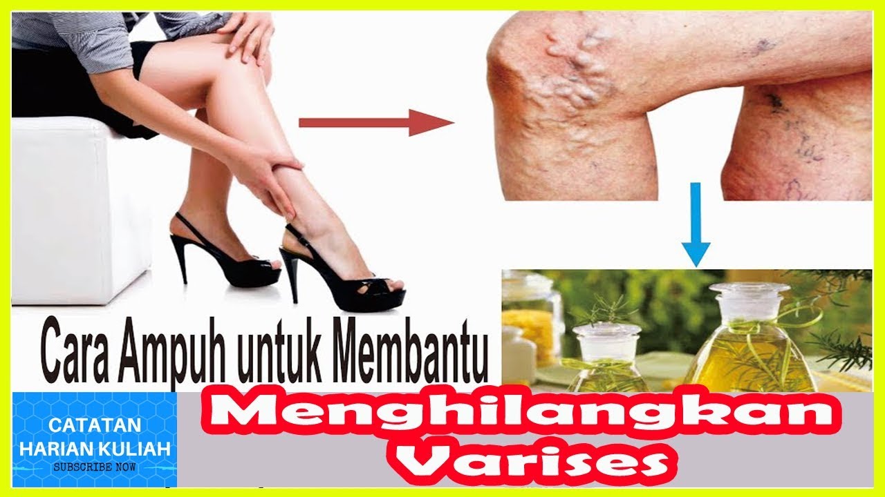 Harus Tahu!!! Cara Menghilangkan Varises di Kaki secara Alami dengan
