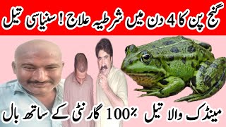 Ganjpan Ka Ilaj Hair Fall And Baldness Treatment Baldness Treatment For Men Hair Fall Solution