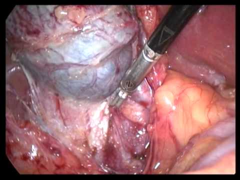 Lap. Cholecystectomy (unedited-165)-Chr. Cholecystitis In A Previous Rt. Nephrectomy, RCC Case