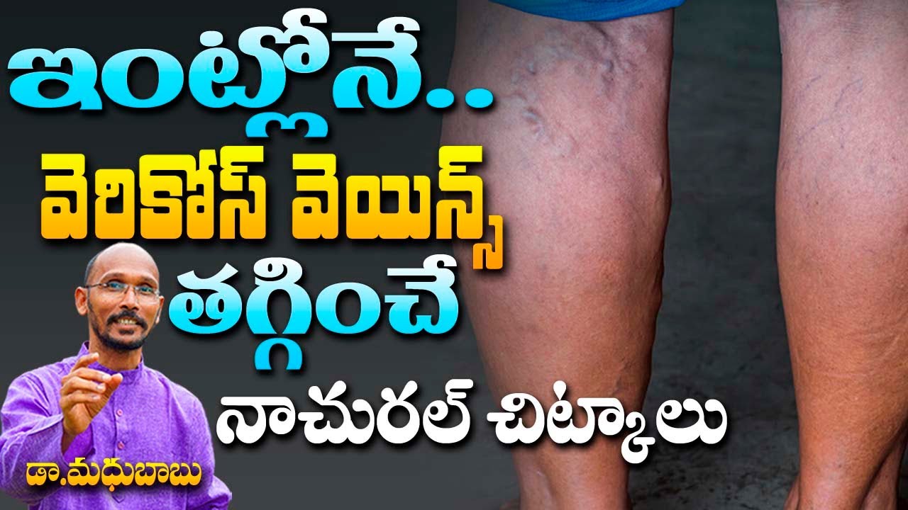 ఇంట్లోనే వెరికోస్ వెయిన్స్ తగ్గించే నాచురల్  చిట్కాలు | Dr. Madhu Babu | Health Trends |