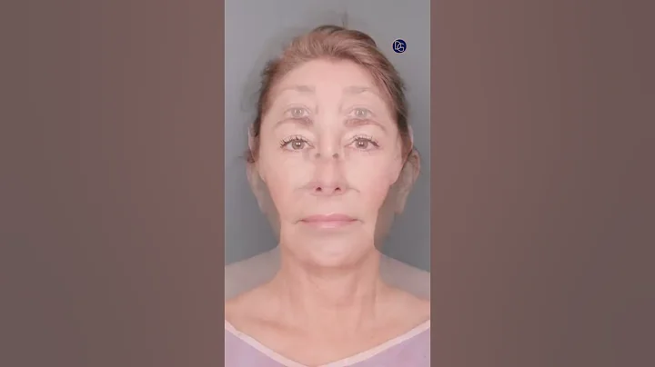 Before & After of a Deep Plane Face & Neck Lift