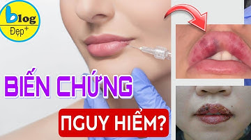 Tiêm filler môi có nguy hiểm không? Những biến chứng thường gặp