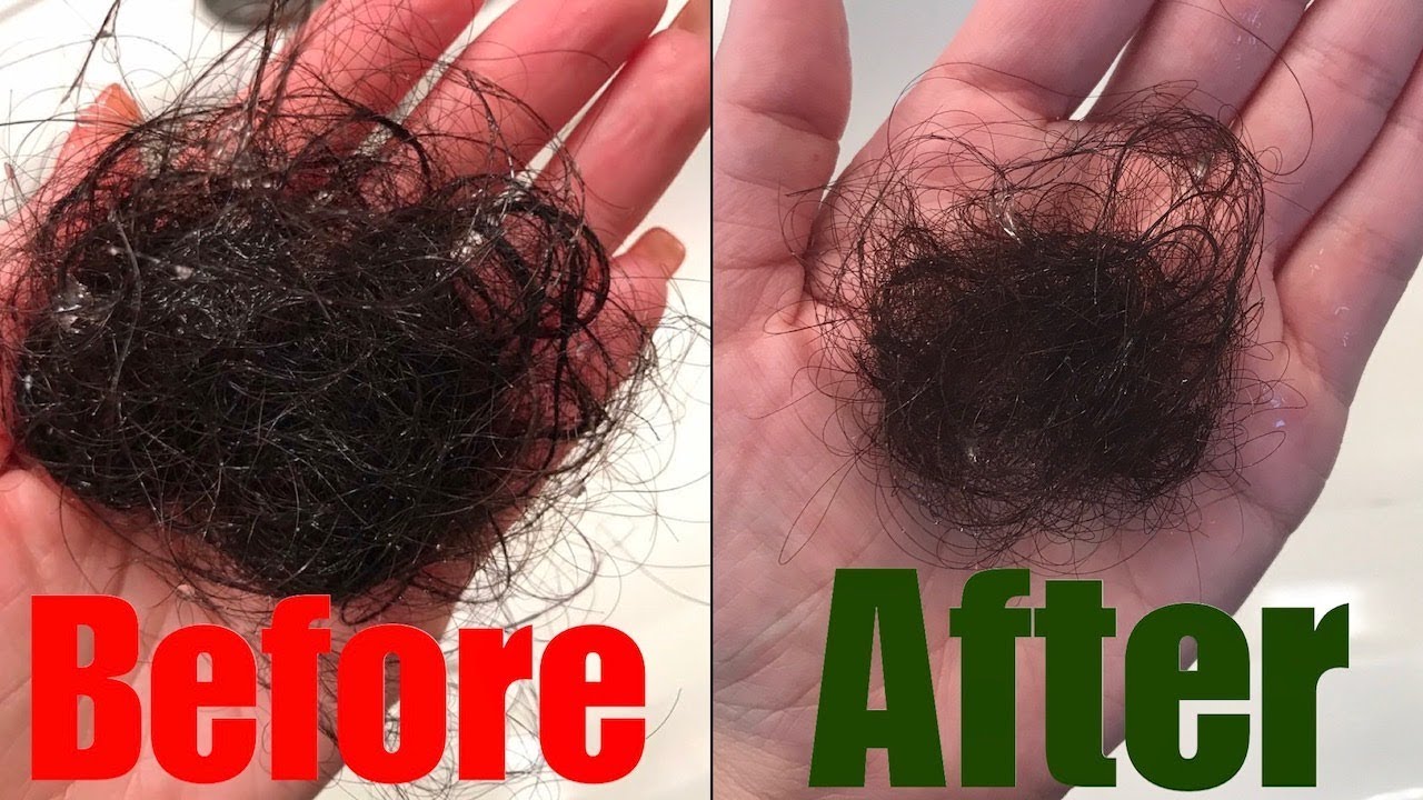Share more than 75 pcos causing hair loss super hot - in.eteachers
