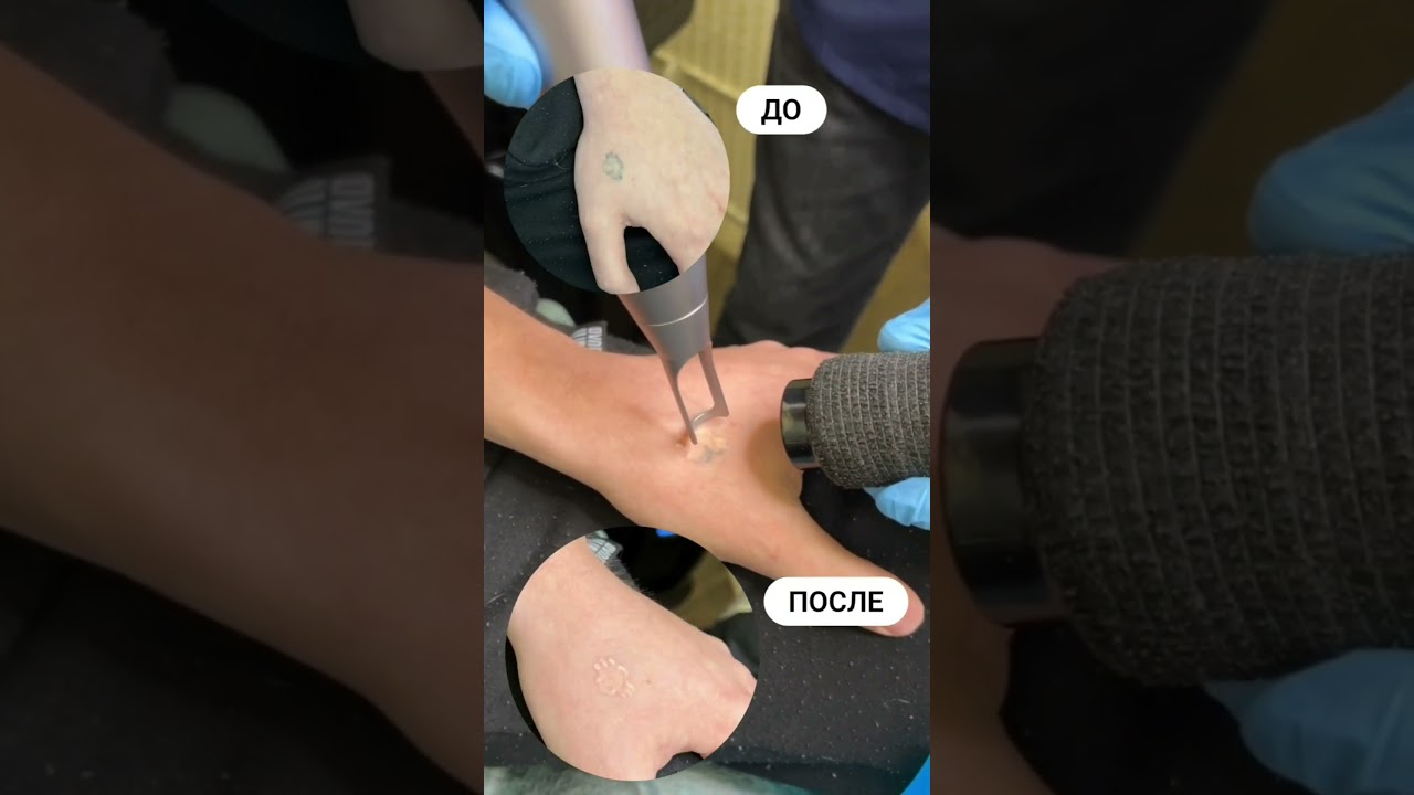 Удаление тату за 6 секунд ‼️ 