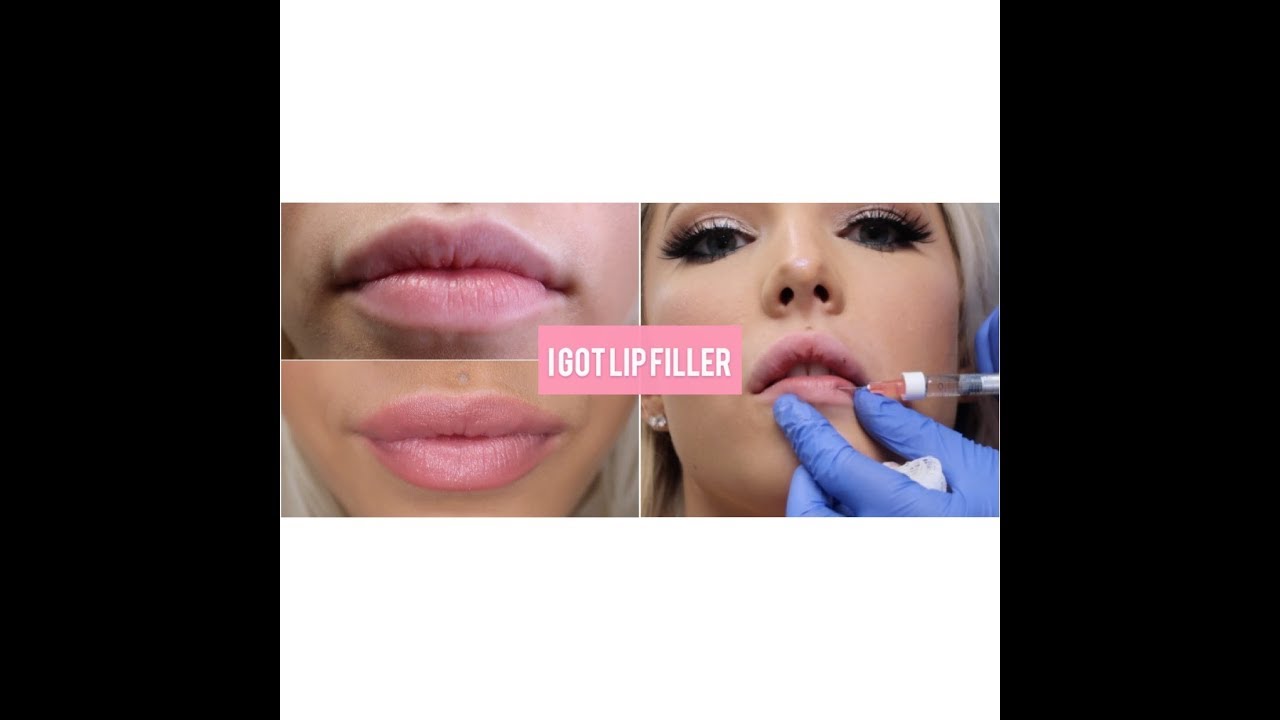 1ST TIME GETTING LIP INJECTIONS - YouTube