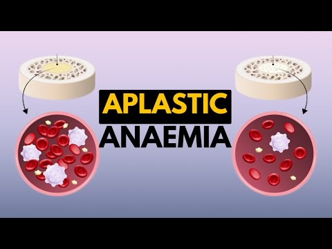 Video: Aplastic Anemia: Symptoms, Diagnosis, Treatment, Prognosis, Causes