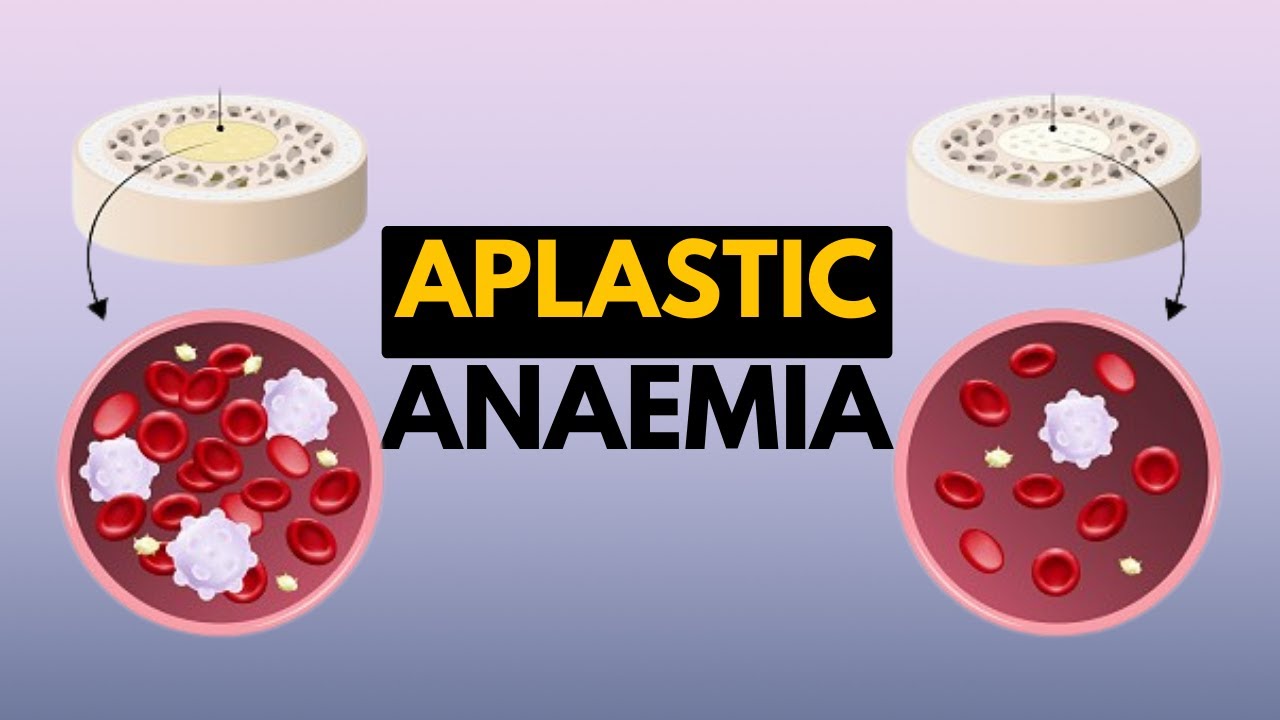 Anemia aplastic