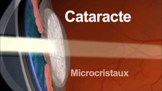 La Cataracte Quest-Ce Que Cest ?