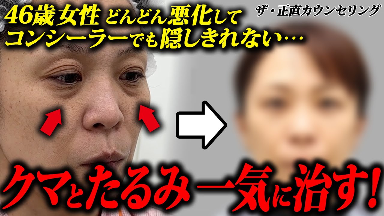 クマ取りで若返り】隠すメイク卒業！40代女性のクマとたるみ改善の複合