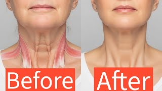 Lift & Sculpt Your Neck Naturally | Massage for Turkey Neck & Platysma