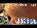 ECZEMA HELP, TREATMENT, and TIPS FOR TODDLER with WET WRAP - Growing Daily | Family Daily Vlog