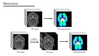 ExSwin-Unet: An Unbalanced Weighted Unet with Shifted Window and External Attentions