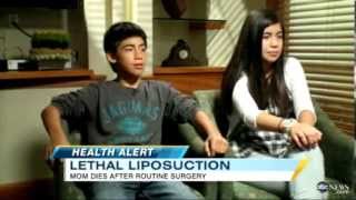 Liposuction Risks Woman Dies After Procedure
