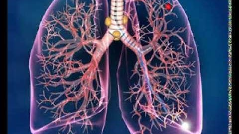 Electromagnetic Navigation Bronchoscopy (ENB) Procedure