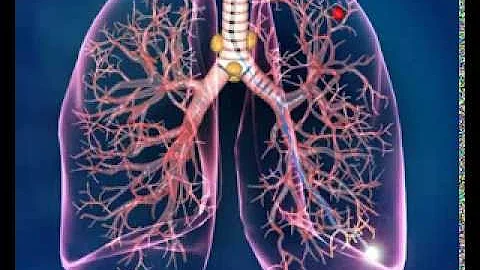 Electromagnetic Navigation Bronchoscopy (ENB) Procedure