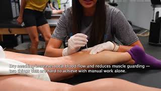 Runner Recovery: Dry Needling, Cupping & Scraping for Tight Calves