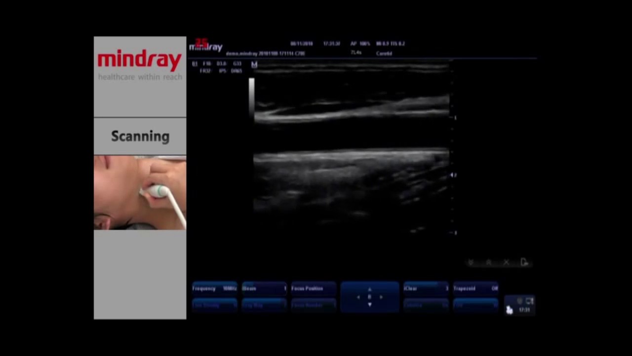 Портативный УЗИ аппарат MINDRAY M5