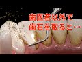 歯石除去を自分でやっても大丈夫？黒い大量の歯石を放置すると・・・