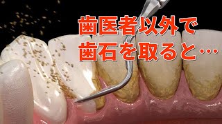 歯石除去を自分でやっても大丈夫？黒い大量の歯石を放置すると・・・