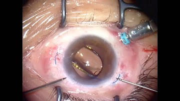 Sutureless intrascleral intraocular lens fixation – Supplementary Video [ID 101515]
