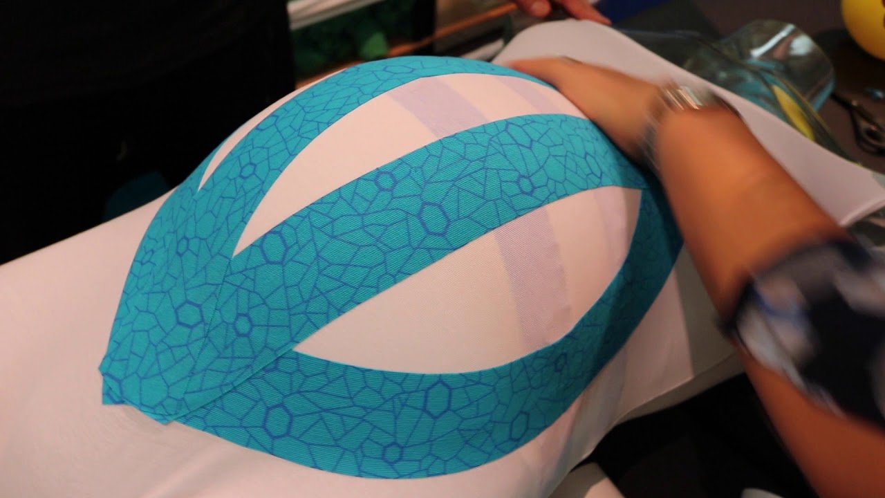 Masking the Pain of Pregnancy with Kinesiology Tape– Carex