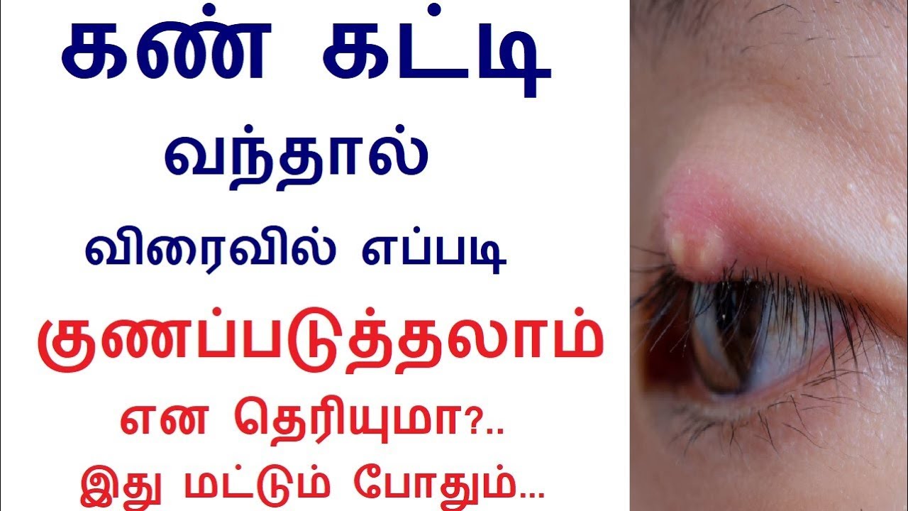 Sty (Stye) Causes, Treatment, Symptoms, Remedies in Tamil Rahul Eye