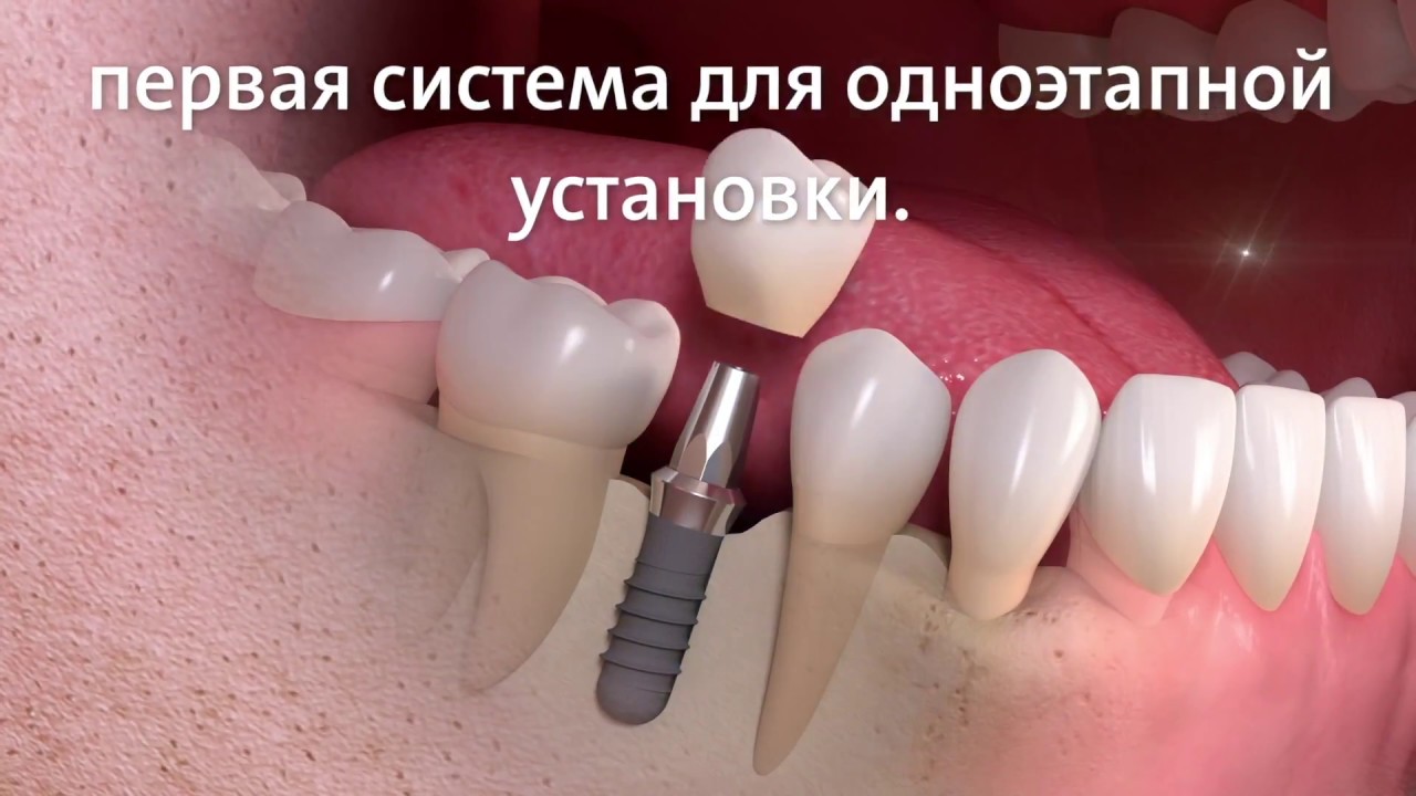 Импланты Straumann. Швейцарская система для имплантации. Зубные ...