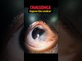 Diagnose this condition? Eye disorder | #shorts #viral #relatable #ophthalmology #optometry