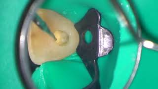 Preventing perforation