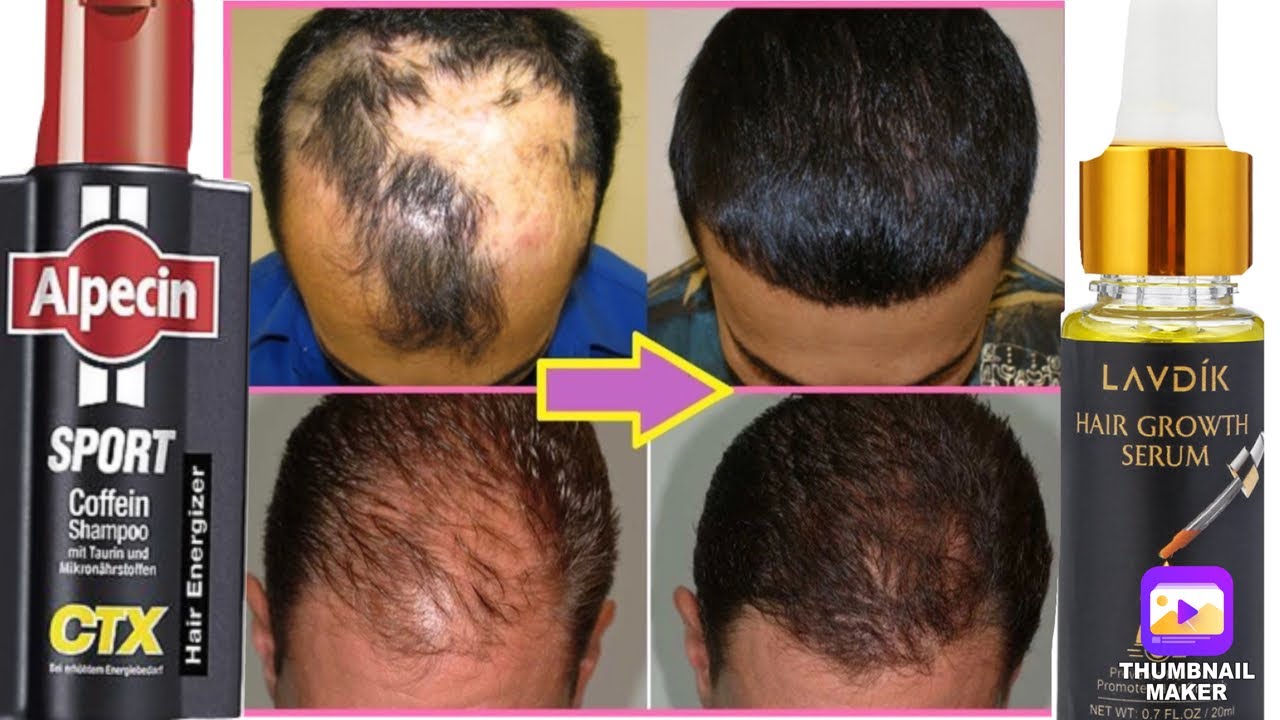 Do This Crazy Hair Growth ALPECIN CAFFEINE shampoo with LAVDIK hair