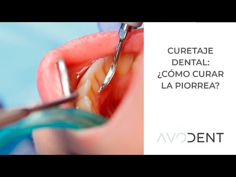 Curetaje dental. ¿cómo se cura la piorrea? | Clínica dental en Alcobendas | Avodent