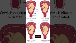 What Does It Mean When Your Cervix Is Dilated? #CervixDilation #PregnancyTips