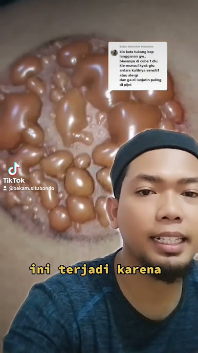 Blaster / bulla / kulit melepuh setelah ber bekam