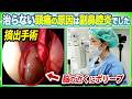 治らない頭痛の正体は副鼻腔炎。脳に迫る巨大ポリープを摘出した手術を耳鼻科医が解説