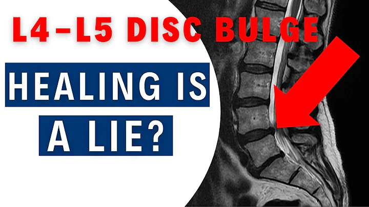 What You Don’t Know About L4-L5 Disc Healing Will Shock You | Dr. John Zielonka