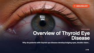 Overview Of Thyroid Eye Disease