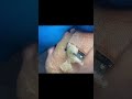 Charming Pedicure Video ~ Remove Dead Skin #foot #paronychie #satisfying#shorts
