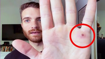 Man Diagnosed With Monkeypox Says It