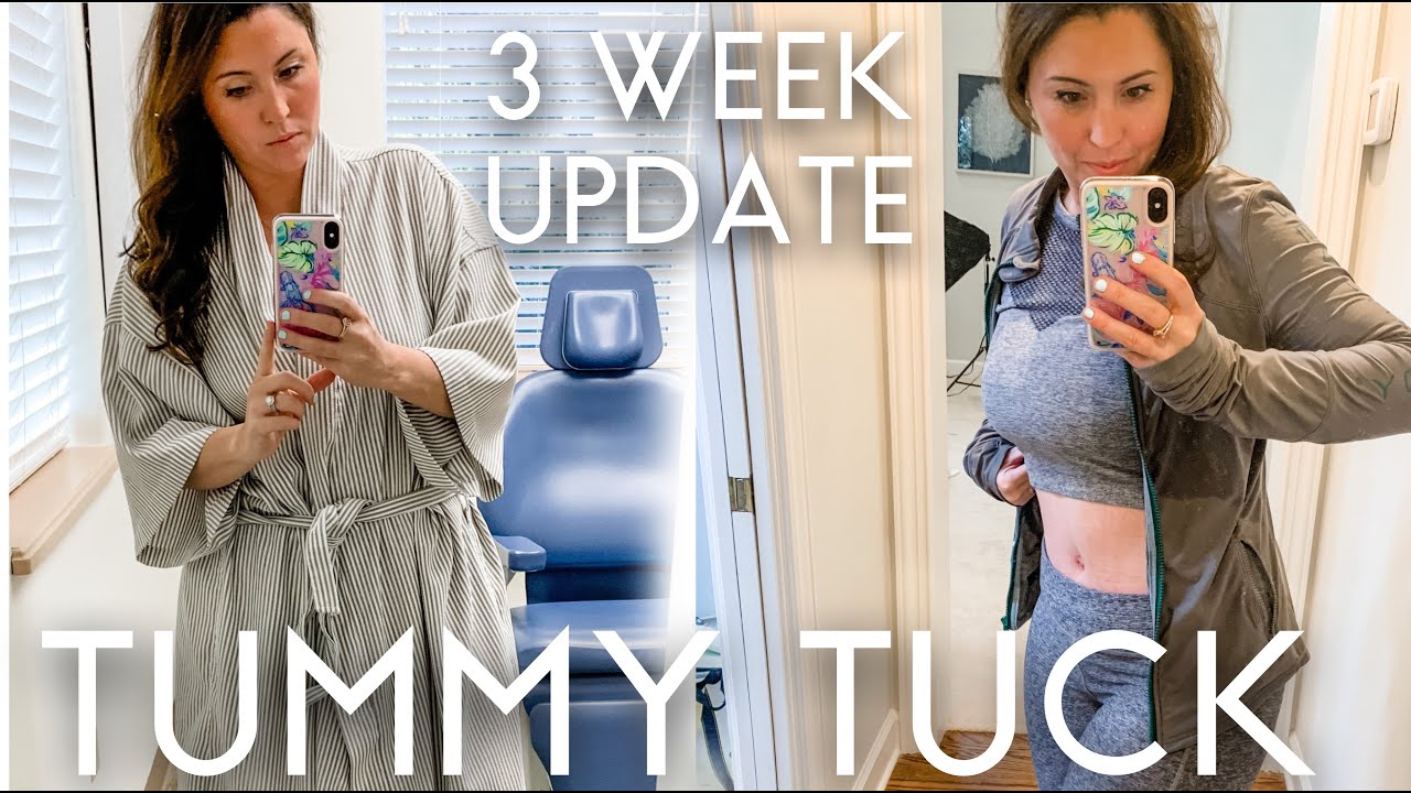 Tummy Tuck 3 Week Update  Before and After Pictures & Full