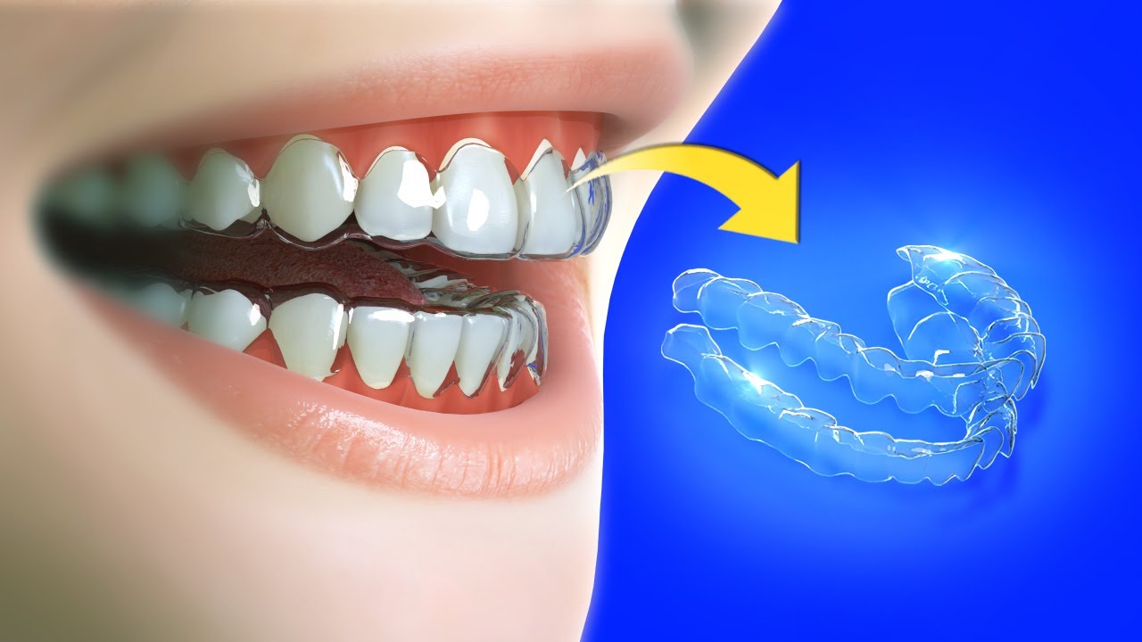 CLEAR ALIGNERS How Clear Aligners Work INVISALIGN Orthodontic