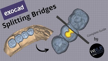Exocad - Splitting Bridges