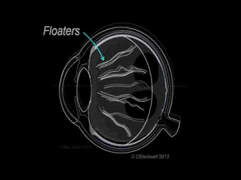 Vitreous 1: Vitreous Aging and Floaters