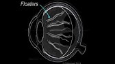 GET RID OF EYE FLOATERS | Natural Treatment For Floaters In The Eyes - YouTube