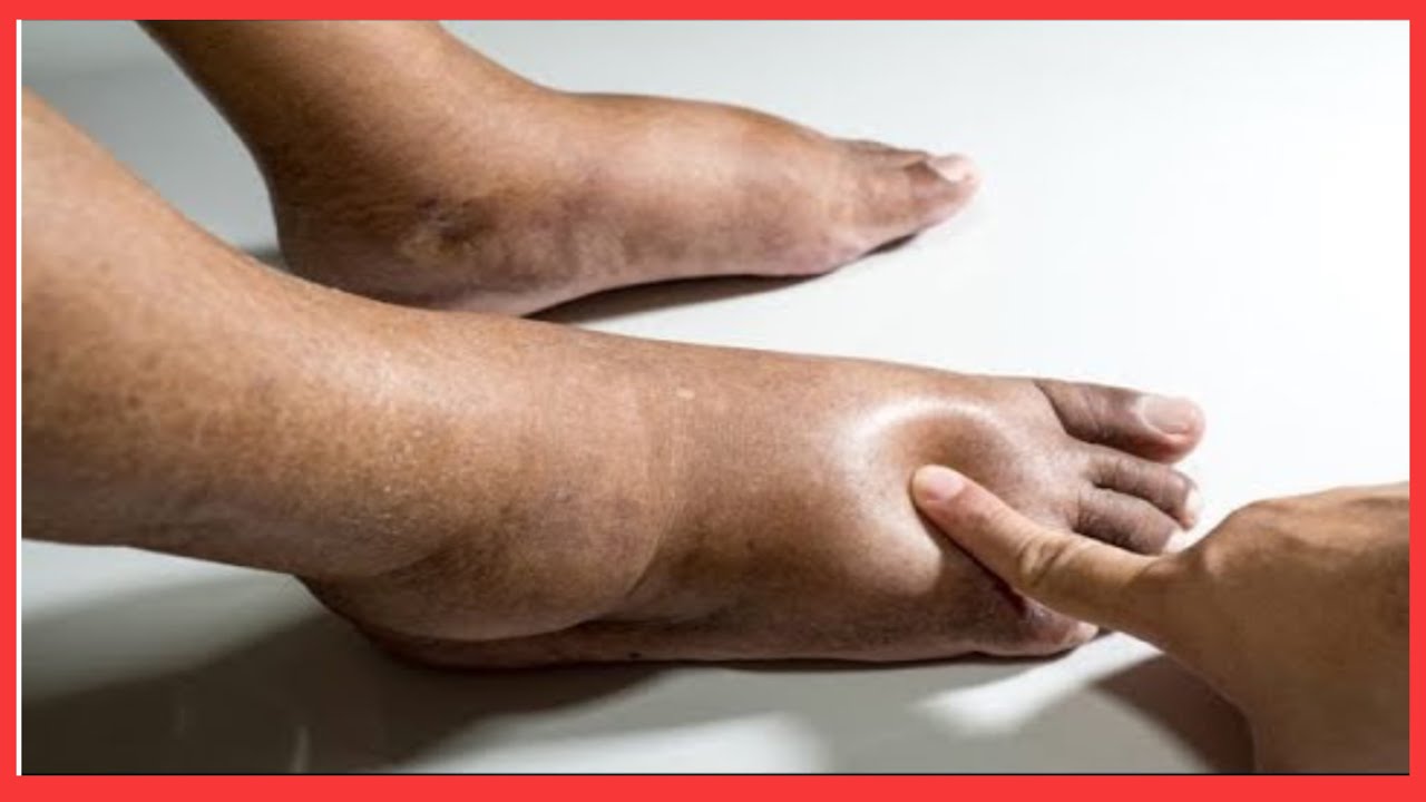 Le plus Puissant SECRET pour arreter la RÉTENTION DE LIQUIDE et RÉDUIRE