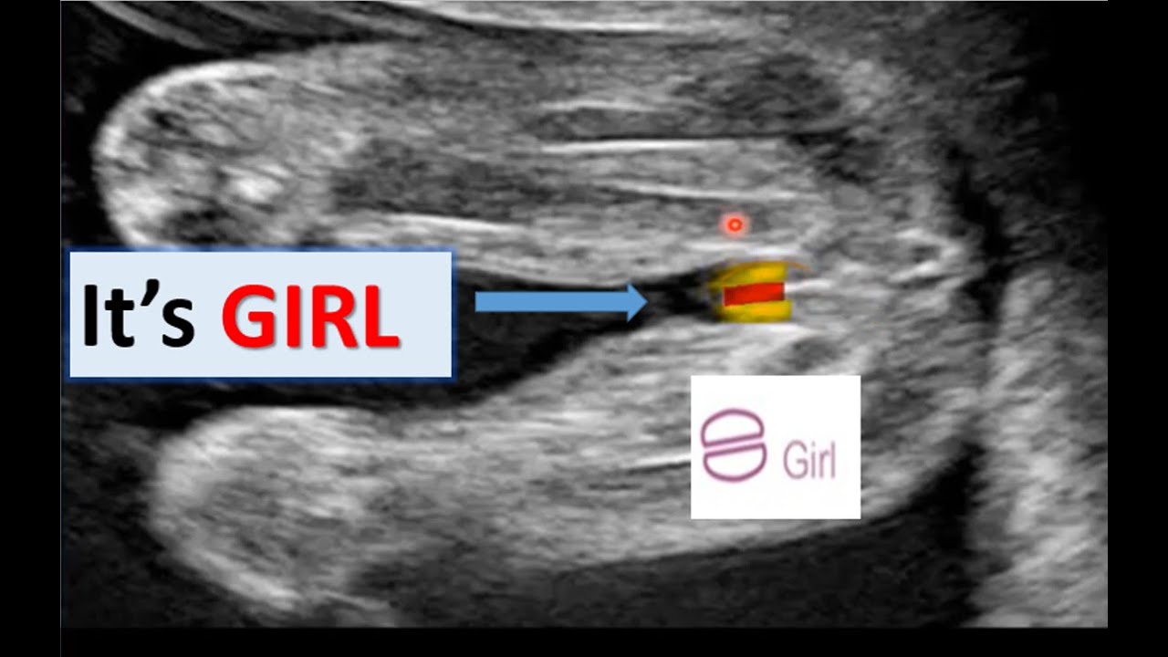 Ultrasound Scan Showing Baby Girl Its Baby Girlknow Your Baby