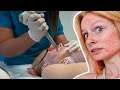 Getting Acne + Scarring LASER Treatment